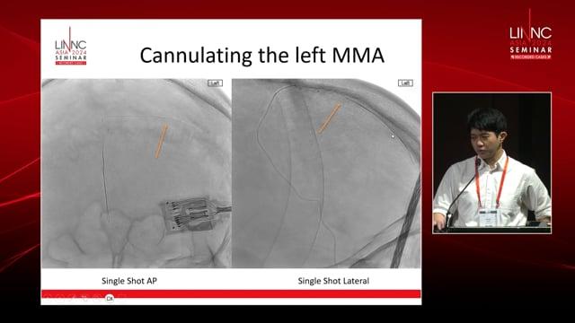 One Feeder, Tackle All – Treating An Ethmoidal Dural Arteriovenous Fistula with Venous Aneurysm and Multiple Feeders