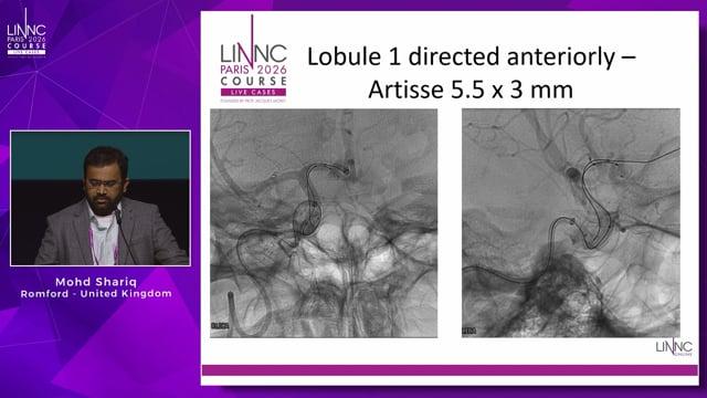 Kiss and Seal: A Novel Intrasaccular Approach