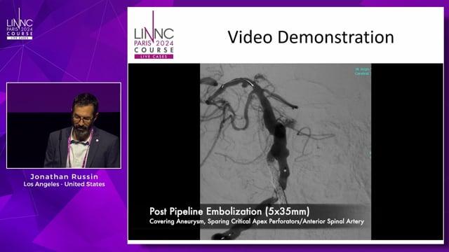 Combined V3 Access Basilar Aneurysm