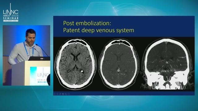 High grade torcular DAVF: Straightforward sacrifice of the straight sinus?