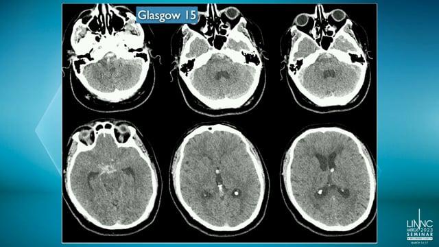 Ruptured blood-blister-like basilar artery aneurysm treated by stent-jacking with flow diverter and coiling