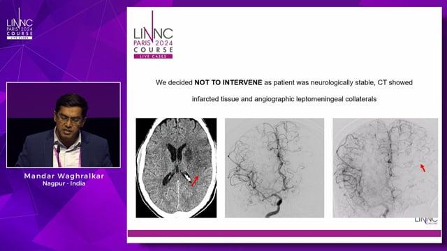 Predicting the unpredictable course of events after a Flow Diverter placement- Managing the unstoppable complexity