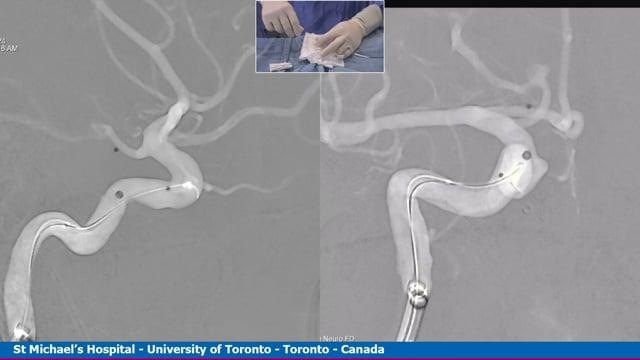 Live Case Transmission from St Michael's Hospital, Toronto, Canada - Coiling of an unruptured right P1-P2 aneurysm through the PComA