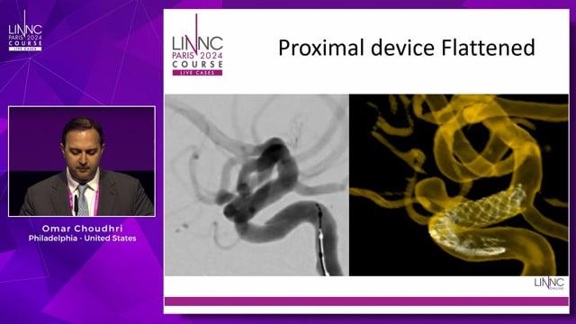 Transcirculation Stenting for Flow Diverter Non opening