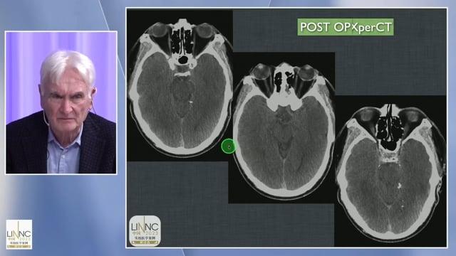 Posterior circulation stroke treated with thrombectomy