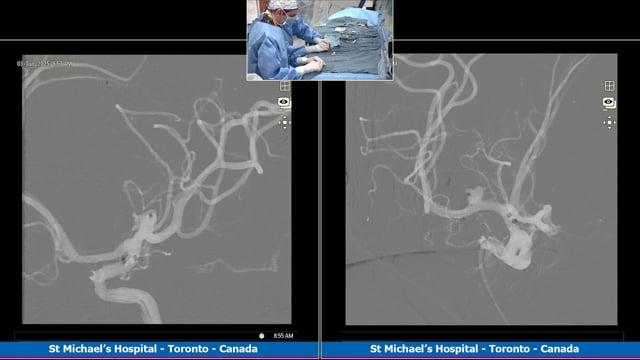 Right MCA aneurysm treated with intrasaccular flow diversion after two failed attempts
