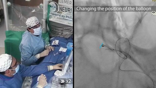 Recorded Cases - Bicêtre Hospital, Paris - Treatment of a fenetrated ruptured Acomm aneurysm using a Tetra coil and balloon remodelling