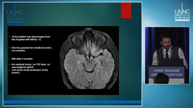 Intraarterial treatment of iatrogenic vasospasm and compression damage of bilateral ICA, ACA and Acom, after transnasal removal of giant pituitary adenoma