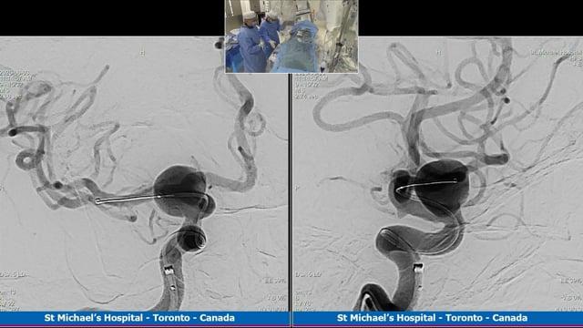 Giant right carotido-ophtalmic aneurysm treated with a FD