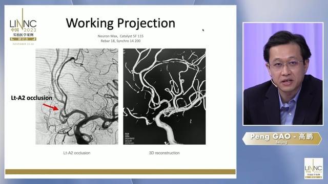 Mechanical thrombectomy for acute occlusion of Lt-A2 with underlying intracranial stenosis
