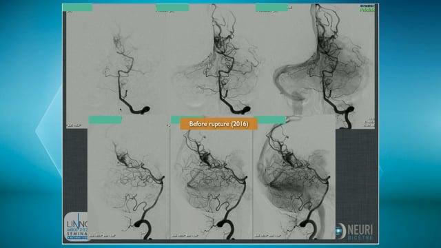 Transarterial embolization of an occipital AVM remnant