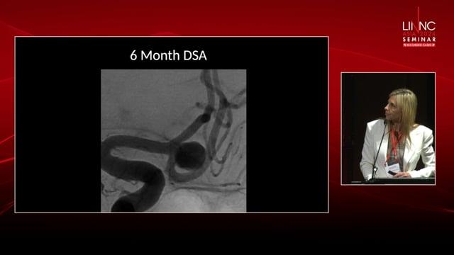 A Simple Acomm Aneurysm