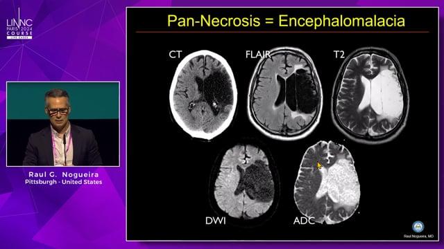 Endovascular Treatment of Large Infarcts: the End of a Journey