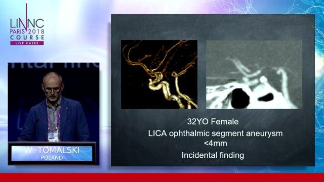 Small ophthalmic aneurysm story