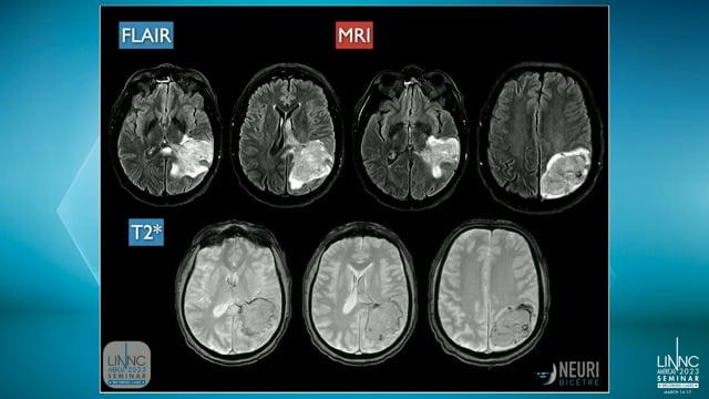 Transvenous embolization of a previously ruptured parito-temporal AVM via a cortical drainage vein