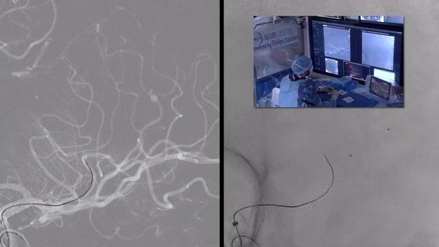 Treatment of a small ruptured dissecting aneurysm of the M4 segment with a flow-diverter