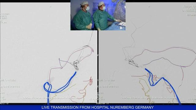 Left recurrent AVF treated by arterial access through the MMA with liquid embolic