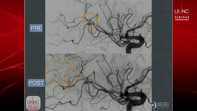 Left distal M2 mechanical thrombectomy with stent retriever