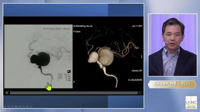 Flow diverter device treatment for giant aneurysm