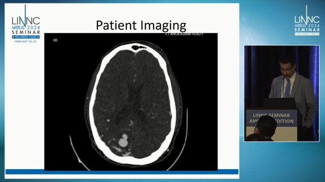 Dural Arteriovenous Fistula Embolization by Combined Transarterial and Transcutaneous Approach