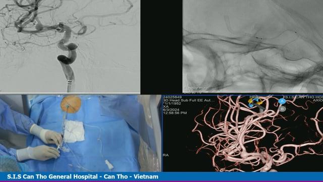 Low profile flow diverter for small but wide neck aneurysm - Live case