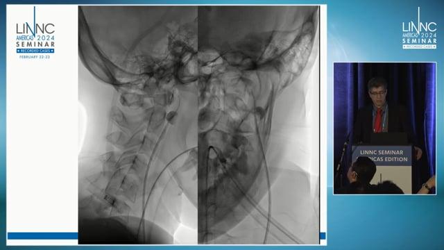 Mechanical Thrombectomy: Novel Technique for Venous Sinus Thrombosis
