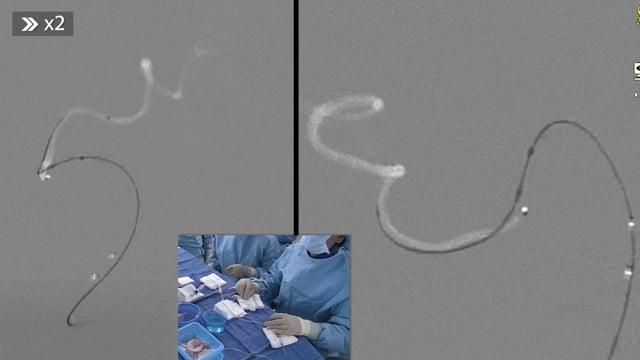 Accessing and treatment of a ruptured cerebellar AVM