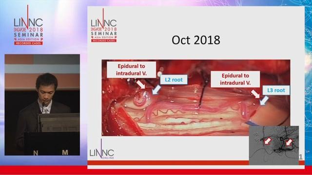 Spinal Extradural Arteriovenous Fistula