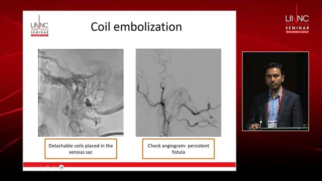 Blocking the buzz - A case of condylar vein dural AVF
