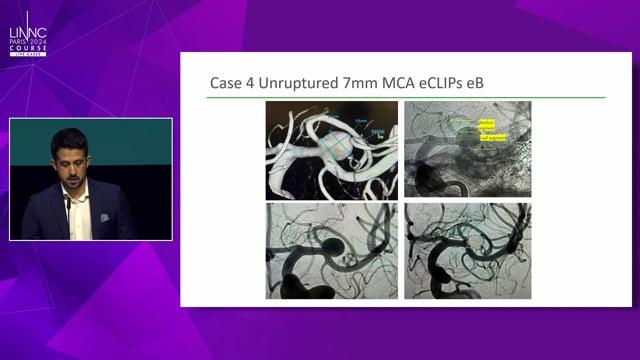 Bifurcation Flow Diverter – eCLIPs