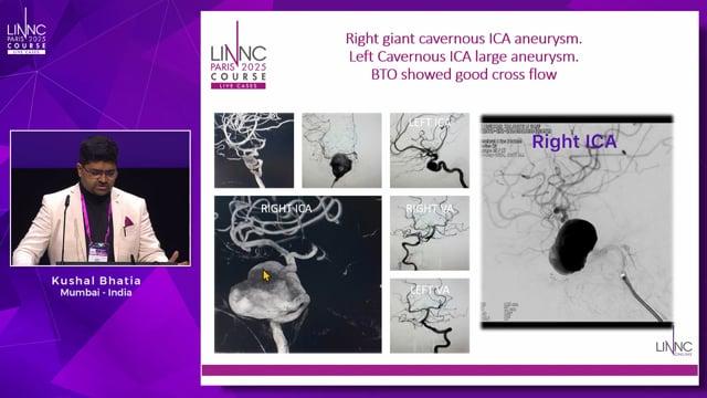 Murphy’s Law: managing a giant ICA aneurysm with complications