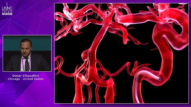 Detour to Cure: A Creative Transcirculation Strategy for a Rare AICA Aneurysm