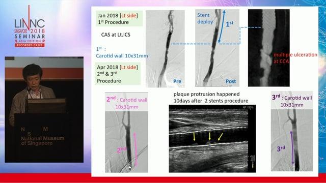 A case of radiation-induced carotid stenosis with renal impairment 