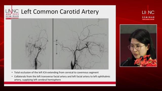 Penetrating cerebrovascular injuries with retained foreign bodies