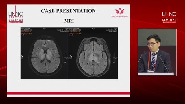 A case of mechanical thrombectomy for deep cerebral vein thrombosis