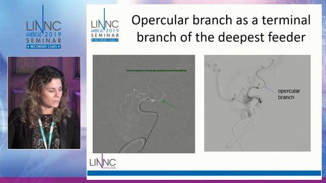 Combined endovascular and microsurgical approach for a left opercular AVM