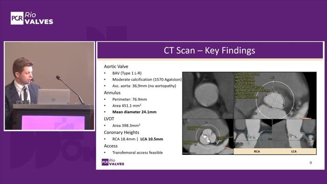 Management of aortic