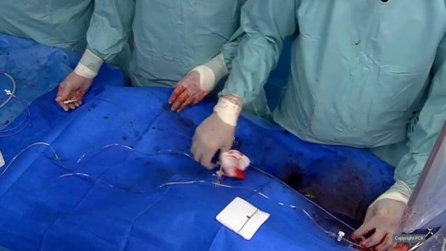 TAVI in bicuspid aortic