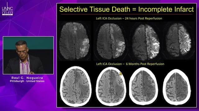 Ten years after thrombectomy: how do we improve outcomes in the patients who still don’t benefit?