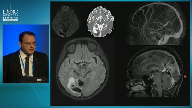 Falcotentorial arteriovenous fistula embolisation complicated by occiptal hematoma