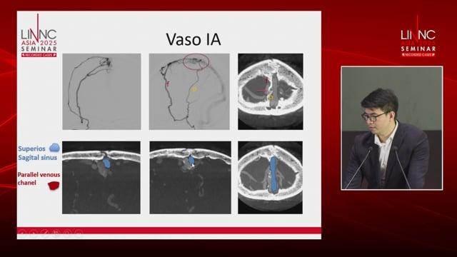 Complex Superior Sagittal Sinus dAVF: Endovascular Management with Combined Approaches