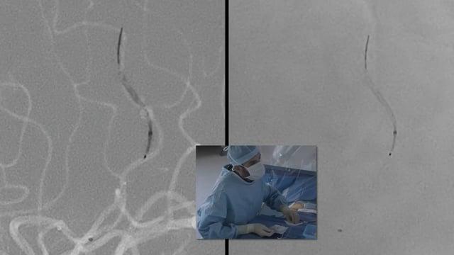 Recorded Cases - Bicêtre Hospital, Paris - Imaging assessment during Clinical Work-up is important: Mycotic M4 Sylvian Aneurysm mistaken for ischemic stroke, treated using flow diversion