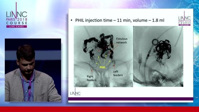 VGAM embolization in infant using Precipitating Injectable Emboli 