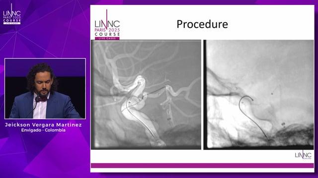 Transcirculation Approach For Pcom Aneurysm Treatment Using T Configuration Stenting With Flow Diverter, Braided Stent And Coils