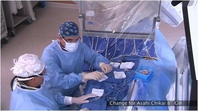 Y stenting with atlas stent for a recanalised Acom aneurysm