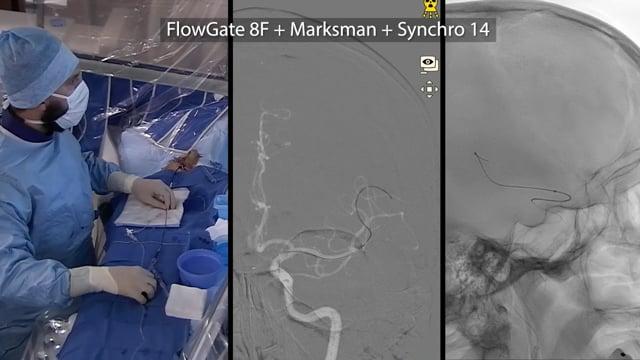 Timely recanalization of a left M2 occlusion in a low-NIHSS stroke