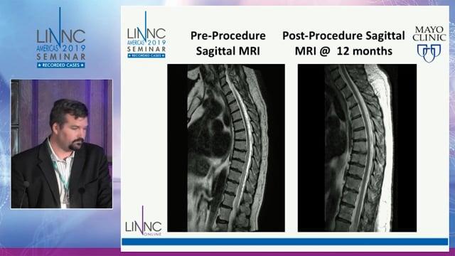 Spinal AVF secondary to venous hypertension from pelvic AVF and a proposal for modified spinal AVF classification
