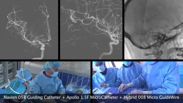 Aneurysm treatment & Ischemic stroke