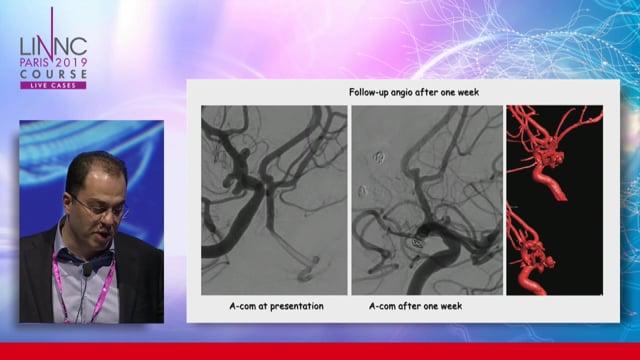 Endovascular Treatment of Brain Aneurysms