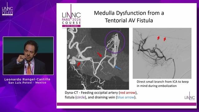 Progressive Quadraparesis and Medulla Oblongata Dysfunction from a Tentorial AV Fistula – EVT embolization cure